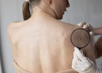 Kampanja ‘SaveYourSkin’ – Obavljeno 1894 besplatnih preventivnih pregleda madeža