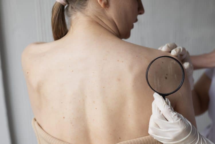 Kampanja ‘SaveYourSkin’ – Obavljeno 1894 besplatnih preventivnih pregleda madeža