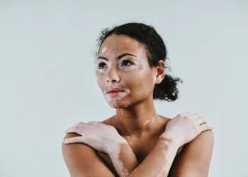 Vitiligo – bolest kože koja ostavlja dubok psihološki trag