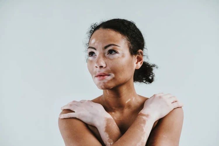 Vitiligo – bolest kože koja ostavlja dubok psihološki trag