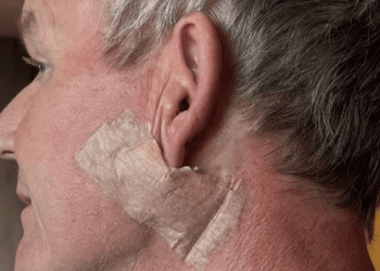 Gordon Ramsay objavio da je imao rak kože